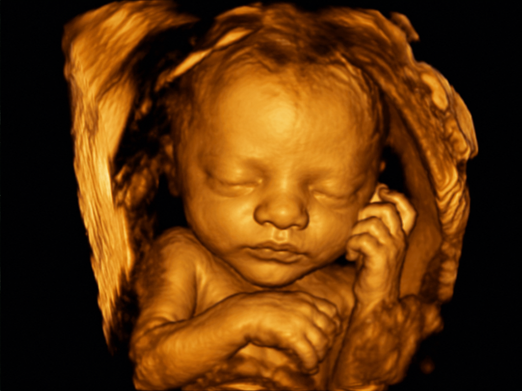3D fetal ultrasound image