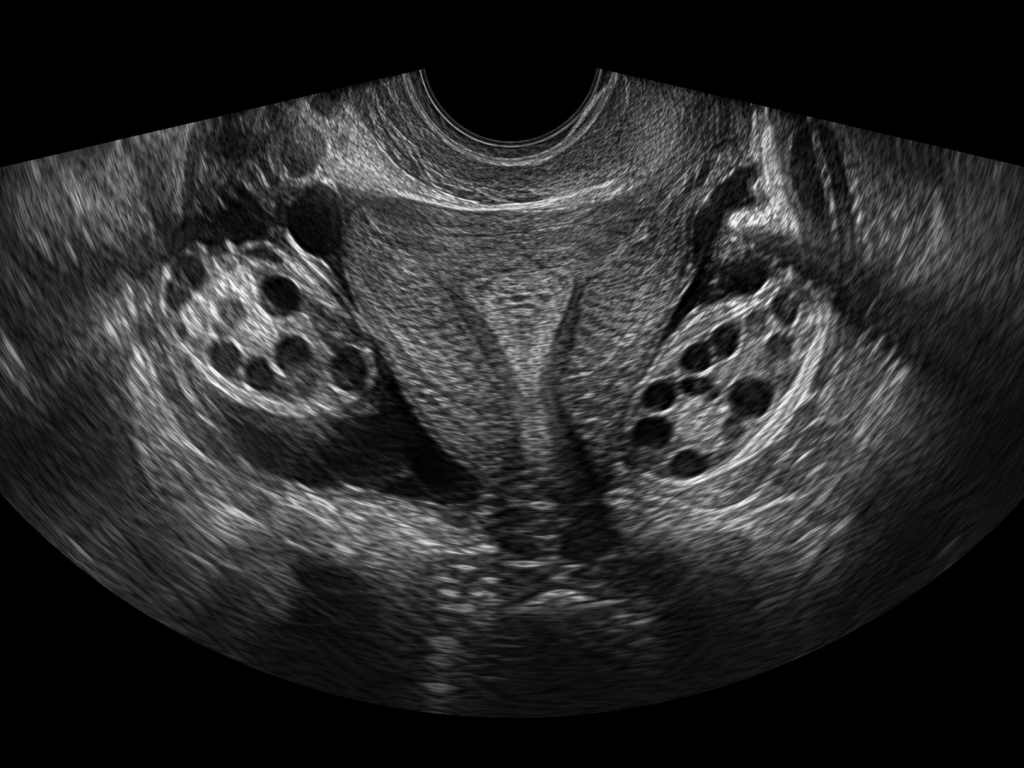 Pelvic ultrasound scan image